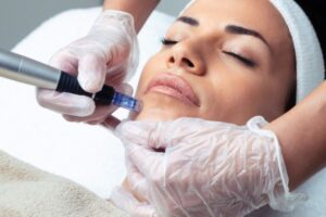 dermapen mejora la flacides